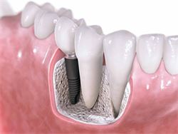Tand implantater